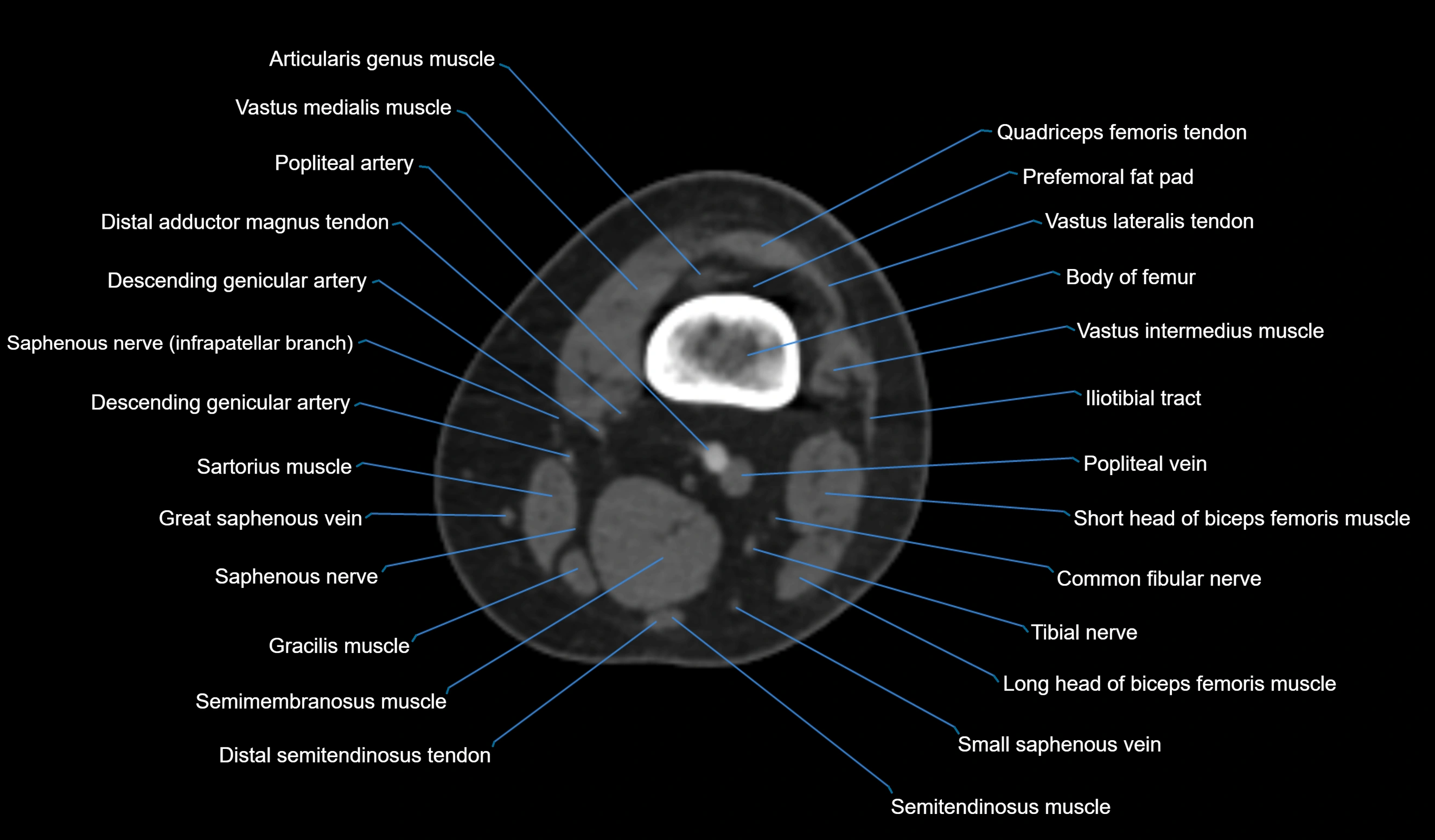 CT knee axial cross sectional anatomy labelled image-00013.webp
